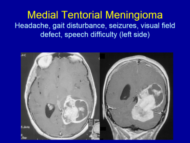 Medial Tentorial Meningioma