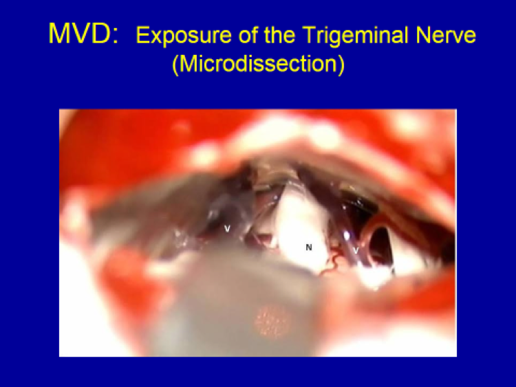 MVD Exposure of the Trigeminal Nerve