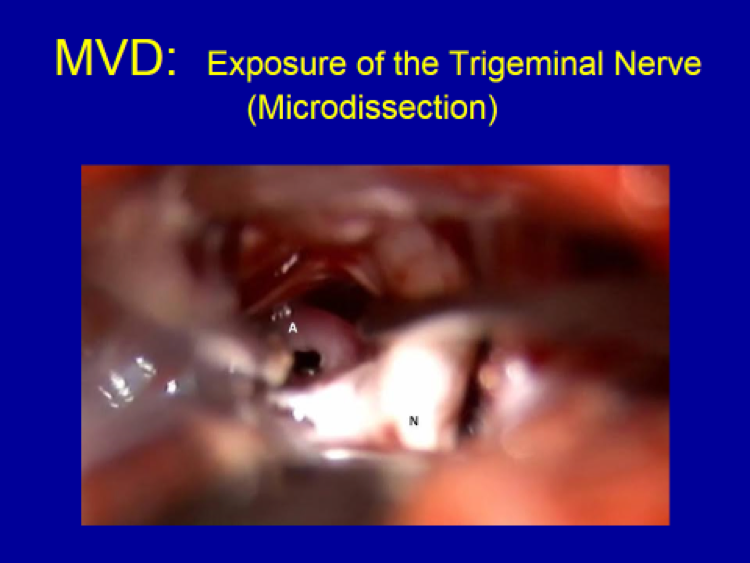 MVD Exposure of the Trigeminal Nerve