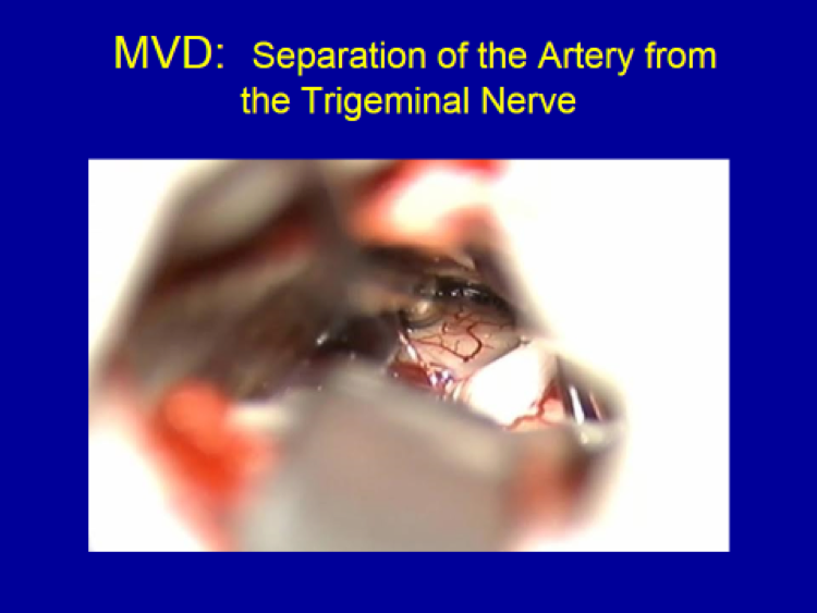 MVD Separation of Artery from Trigeminal Nerve