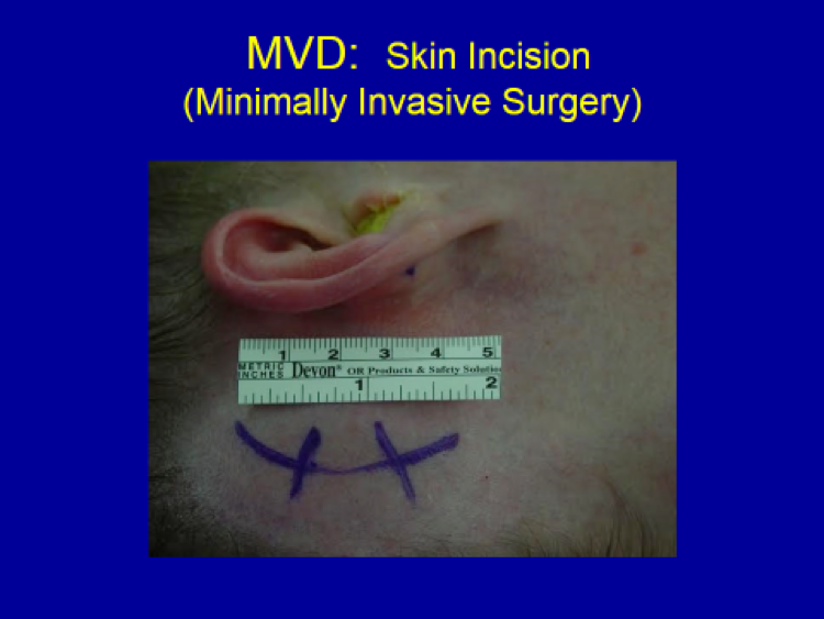 MVD Skin Incision