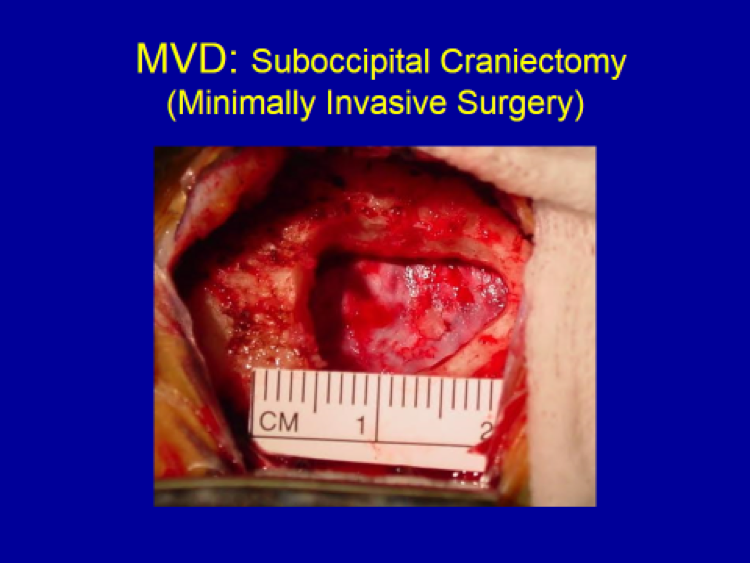 MVD Suboccipital Craniectomy