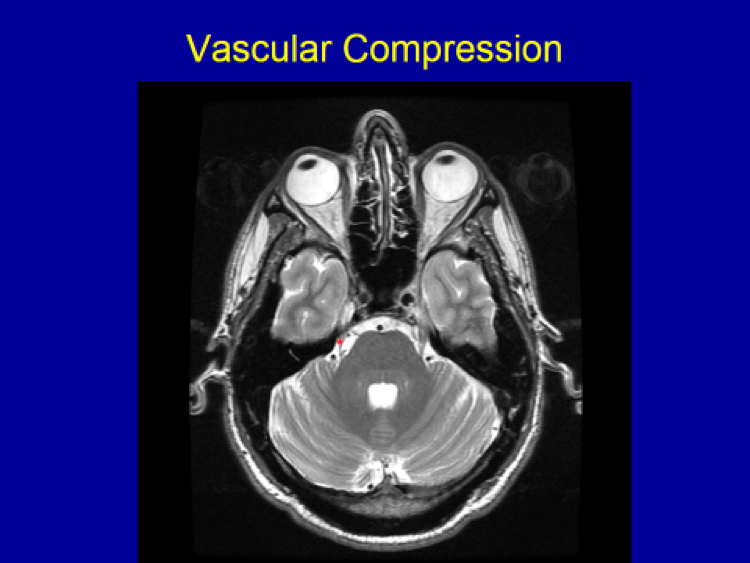 Vascular Compression