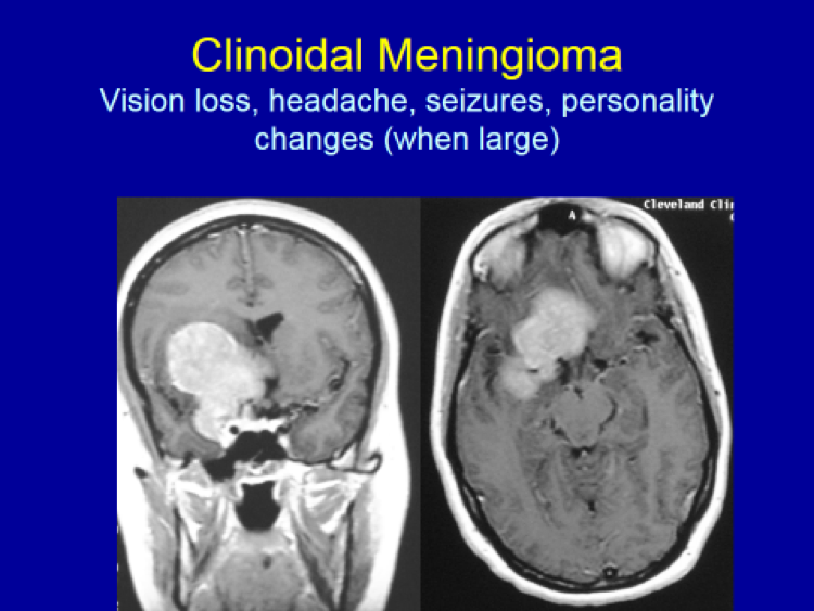 Clinoidal Meningioma