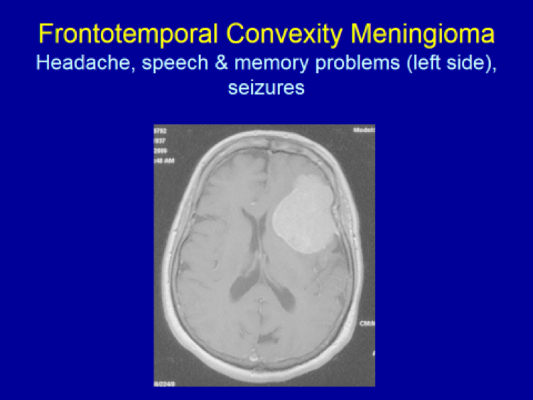 Frontotemporal Convexity Meningioma