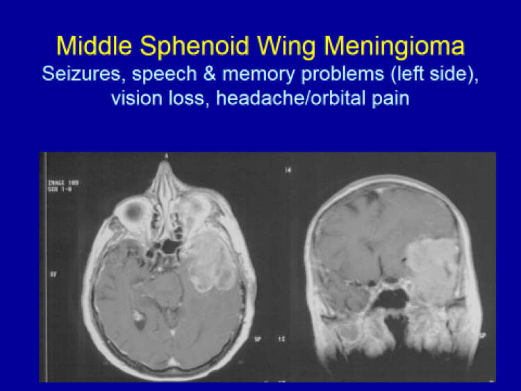 Middle Sphenoid Wing Meningioma