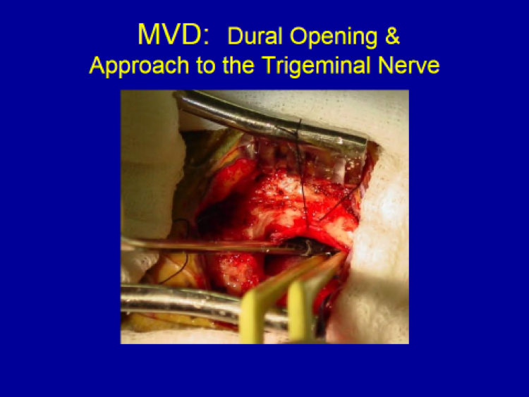 MVD Dural Opening and Approach to the Trigeminal Nerve