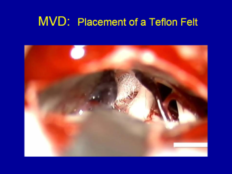 MVD Placement of a Teflon Felt